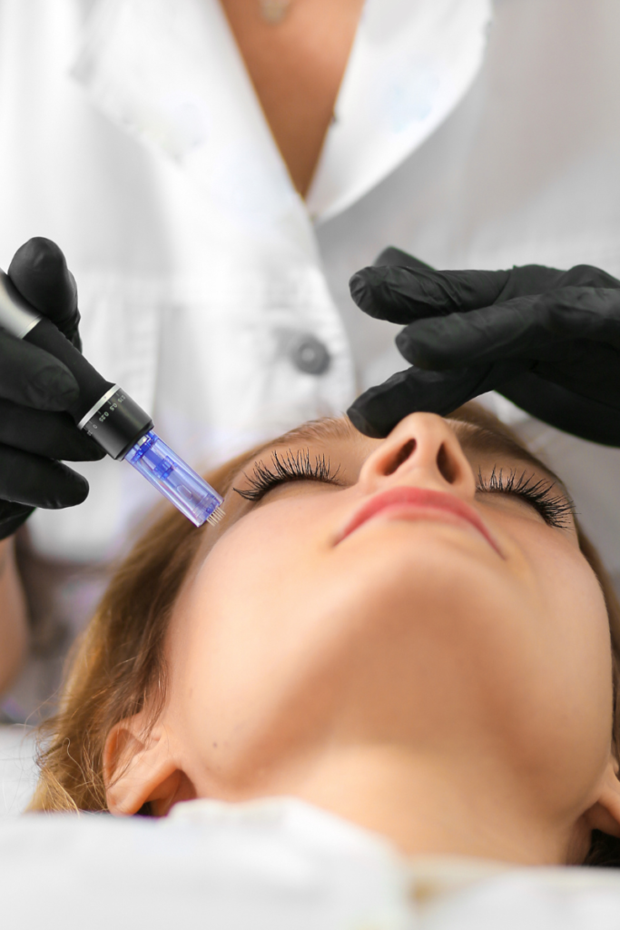 Microneedling-tratamiento-clínicas-estéticas-aura